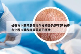 長(zhǎng)春市中醫(yī)院總部治牛皮癬治的好不好 長(zhǎng)春市中醫(yī)皮膚科哪里最好的醫(yī)院