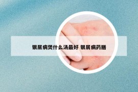 銀屑病煲什么湯最好 銀屑病藥膳