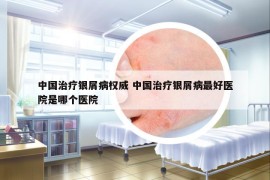 中國(guó)治療銀屑病權(quán)威 中國(guó)治療銀屑病最好醫(yī)院是哪個(gè)醫(yī)院