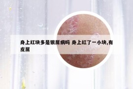 身上紅塊多是銀屑病嗎 身上紅了一小塊,有皮屑