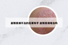 副銀屑病不治的后果知乎 副銀屑病難治嗎