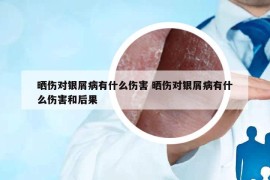 曬傷對(duì)銀屑病有什么傷害 曬傷對(duì)銀屑病有什么傷害和后果