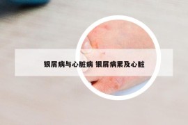 銀屑病與心臟病 銀屑病累及心臟