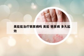 美能能治療銀屑病嗎 美能 銀屑病 多久起效