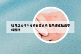駐馬店治療牛皮癬有偏方嗎 駐馬店皮膚病?？漆t(yī)院