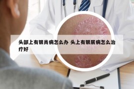 頭部上有銀肖病怎么辦 頭上有銀屑病怎么治療好