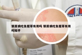 銀屑病吃魚腥草有用嗎 銀屑病吃魚腥草有用嗎知乎