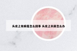 頭皮上有癬是怎么回事 頭皮上長(zhǎng)蘚怎么辦