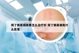 得了銀屑病需要怎么治療好 得了銀屑病有什么危害