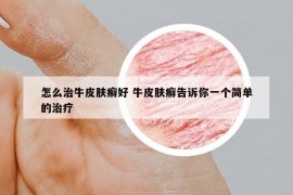 怎么治牛皮膚癬好 牛皮膚癬告訴你一個簡單的治療