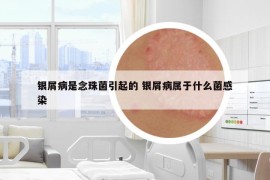 銀屑病是念珠菌引起的 銀屑病屬于什么菌感染