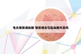 龜頭銀屑病血糖 銀屑病會(huì)引起血糖升高嗎