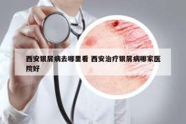 西安銀屑病去哪里看 西安治療銀屑病哪家醫(yī)院好
