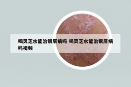 喝靈芝水能治銀屑病嗎 喝靈芝水能治銀屑病嗎視頻