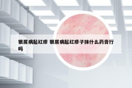 銀屑病起紅疹 銀屑病起紅疹子抹什么藥膏行嗎