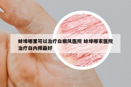 蚌埠哪里可以治療白癜風醫(yī)院 蚌埠哪家醫(yī)院治療白內障最好