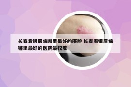 長春看銀屑病哪里最好的醫(yī)院 長春看銀屑病哪里最好的醫(yī)院最權威