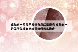 皮膚有一片發(fā)干發(fā)癢有點(diǎn)紅是癬嗎 皮膚有一片發(fā)干發(fā)癢有點(diǎn)紅是癬嗎怎么治療