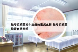 膚專家癬王對(duì)牛皮癬效果怎么樣 膚專家癬王軟膏有激素嗎