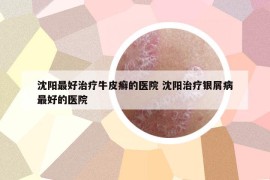 沈陽最好治療牛皮癬的醫(yī)院 沈陽治療銀屑病最好的醫(yī)院