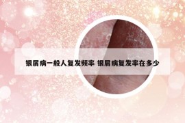 銀屑病一般人復發(fā)頻率 銀屑病復發(fā)率在多少