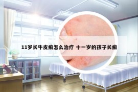 11歲長牛皮癬怎么治療 十一歲的孩子長癬