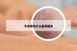牛皮癬為什么越發(fā)越多
