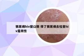 銀屑病hiv窗口期 得了銀屑病去檢查hiv是陰性