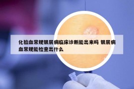 化驗(yàn)血常規(guī)銀屑病臨床診斷能出來嗎 銀屑病血常規(guī)能檢查出什么