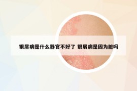 銀屑病是什么器官不好了 銀屑病是因?yàn)榕K嗎