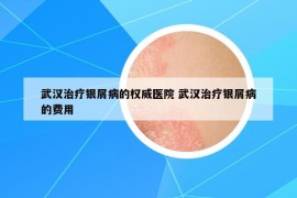 武漢治療銀屑病的權(quán)威醫(yī)院 武漢治療銀屑病的費(fèi)用