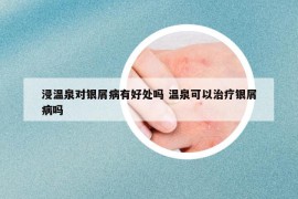 浸溫泉對(duì)銀屑病有好處嗎 溫泉可以治療銀屑病嗎