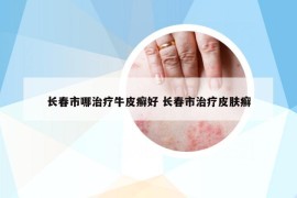 長春市哪治療牛皮癬好 長春市治療皮膚癬
