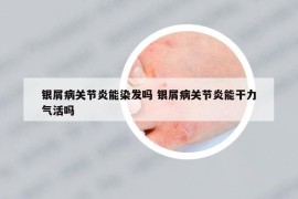 銀屑病關(guān)節(jié)炎能染發(fā)嗎 銀屑病關(guān)節(jié)炎能干力氣活嗎