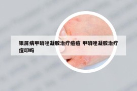 銀屑病甲硝唑凝膠治療痘痘 甲硝唑凝膠治療痘印嗎