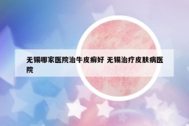 無(wú)錫哪家醫(yī)院治牛皮癬好 無(wú)錫治療皮膚病醫(yī)院