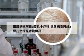 銀屑病吃阿維a要幾個療程 銀屑病吃阿維a要幾個療程才能停藥