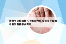 爸爸牛皮癬遺傳兒子概率大嗎 父親有牛皮癬母親沒有孩子會有嗎