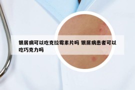 銀屑病可以吃克拉霉素片嗎 銀屑病患者可以吃巧克力嗎