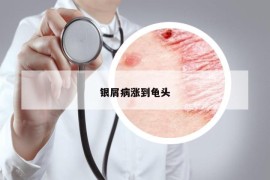 銀屑病漲到龜頭