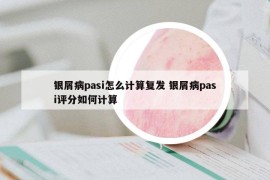 銀屑病pasi怎么計(jì)算復(fù)發(fā) 銀屑病pasi評(píng)分如何計(jì)算