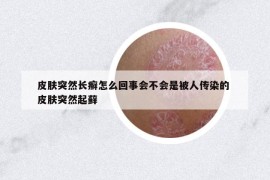 皮膚突然長癬怎么回事會不會是被人傳染的 皮膚突然起蘚
