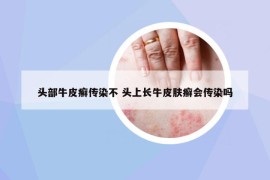 頭部牛皮癬傳染不 頭上長牛皮膚癬會傳染嗎