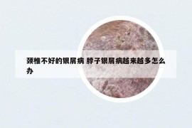 頸椎不好的銀屑病 脖子銀屑病越來越多怎么辦