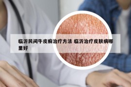 臨沂民間牛皮癬治療方法 臨沂治療皮膚病哪里好