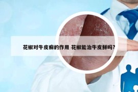 花椒對(duì)牛皮癬的作用 花椒能治牛皮鮮嗎?