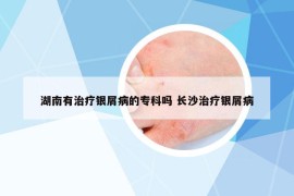 湖南有治療銀屑病的?？茊?長(zhǎng)沙治療銀屑病