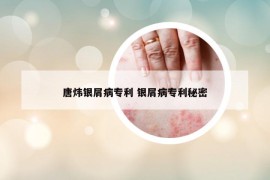 唐煒銀屑病專利 銀屑病專利秘密