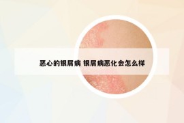 惡心的銀屑病 銀屑病惡化會怎么樣