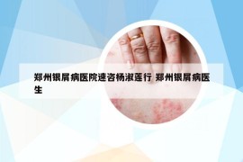 鄭州銀屑病醫(yī)院速咨楊淑蓮行 鄭州銀屑病醫(yī)生